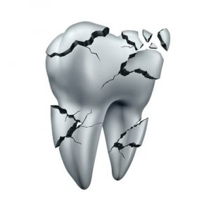 broken or cracked tooth